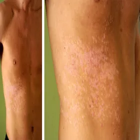 Darier-White disease