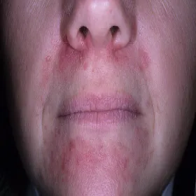 Dermatoza okołoustna u kobiety