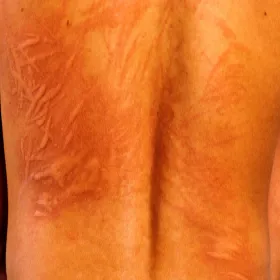 Dermografizm na tle nerwowym