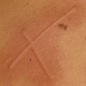 Dermografizm pokrzywkowy