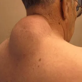 Duża narośl na plecach