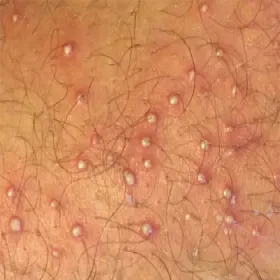 Duże ropne krosty na skórze