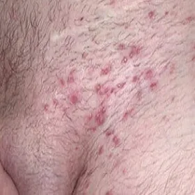 Duże ropne krosty w okolicach intymnych