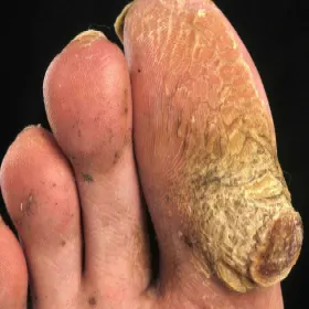 Duży modzel na palcu