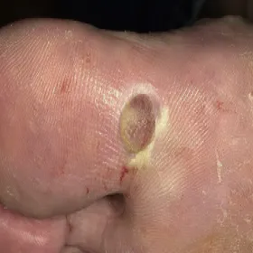 Duży palec u nogi guzek narośl