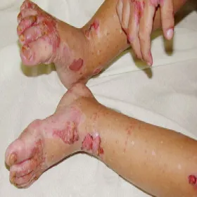 Dziedziczny niedobór cynku u niemowląt zespół Danbolta-Clossa