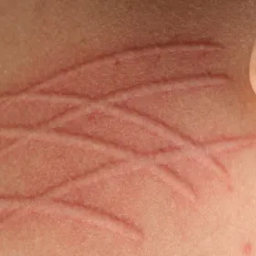 Dziwne choroby skóry dermografizm 