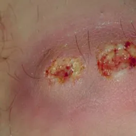 Ecthyma paciorkowiec ropotwórczy 