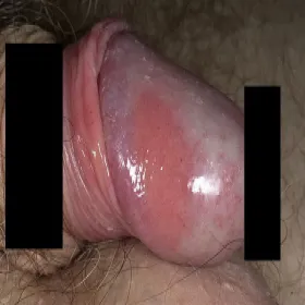 Egzema zapalenie napletka