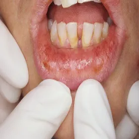 Erythema multiforme na ustach