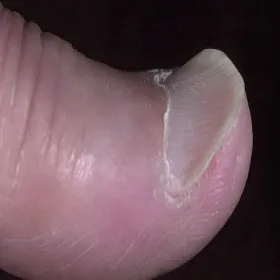 Falista płytka paznokcia koilonychia