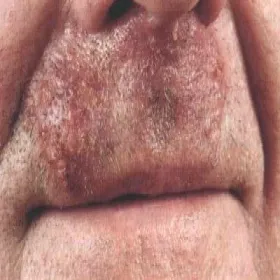 Figówka choroba skóry