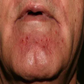 Figówka gronkowcowa broda