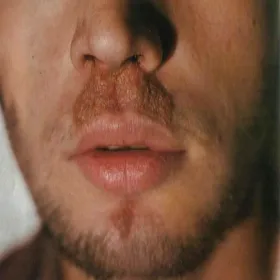 Figówka gronkowcowa zdjęcia