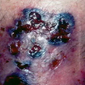 Fioletowy wrzód na skórze piodermia zgorzelinowa