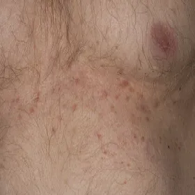 Gęsta wysypka jaskrawoczerwonych grudek na skórze choroba Grovena