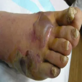 Gangrena mokra stopy