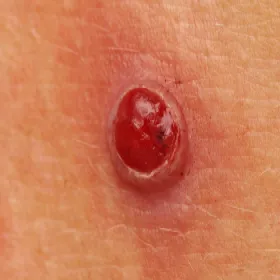 Granuloma teleangiectodes