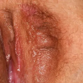 Gruczolaki potowe syringoma miejsc intymnych u kobiet