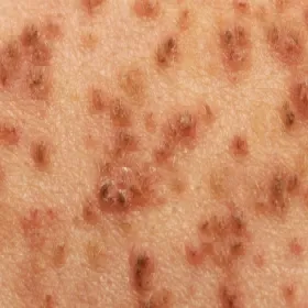 Grudki brązowe na skórze choroba Dariera