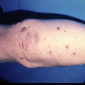 Grudki na łokciach kępki żółte guzkowe