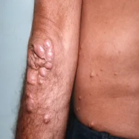 Grudki na łokciach kępki żółte guzkowe 