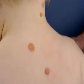 Grudki na plecach u dziecka żółtakoziarniniakowatość młodzieńcza