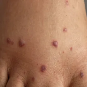 Grudki na skórze choroba Behçeta 