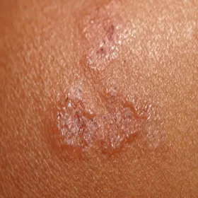 Grudki na skórze choroba Duhringa