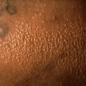 Grudki na skórze liszaj lsniący