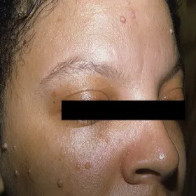 Grudki o barwie cieliste na twarzy