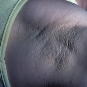 Grudki pod pachą choroba Foxa-Fordyce'a