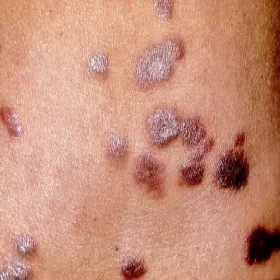 Grudkowatość bowenoidalna grudki na skórze