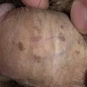 Grudkowatość bowenoidalna zdjęcie