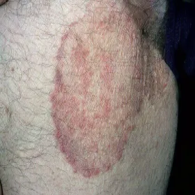 Grzybica fałdów pachwinowych