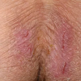 Grzybica między pośladkami