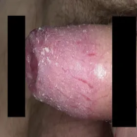 Grzybica napletka zapalenie napletka