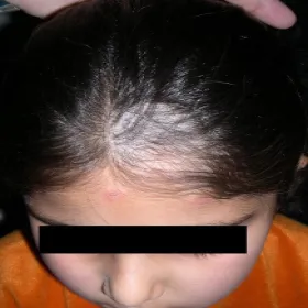 Grzybica owłosionej skóry głowy u dziewczynki