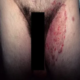 Grzybica uda u mężczyzny