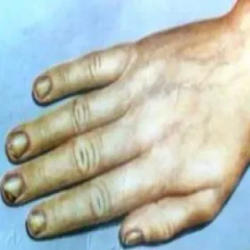 Grzybica woszczynowa na paznokciach