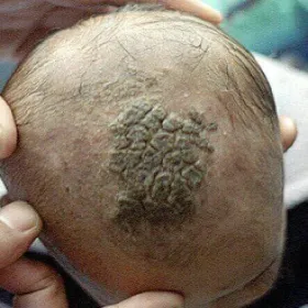 Grzybica woszczynowa z dużymi grubymi strupami