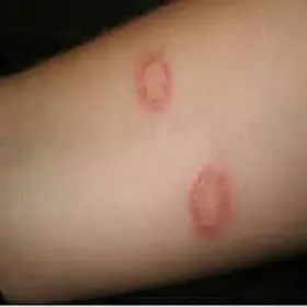 Grzybica skóry u dziecka na ręce