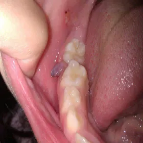 Guz ciążowy na dziąśle