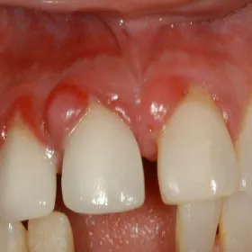 Guz ciążowy, ziarniniak ciężarnych