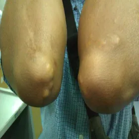 Guz skórny okolicy łokcia kępki żółte guzkowe