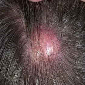 Guzek kaszak na głowie