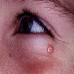 Guzek koło oka mięczak zakaźny