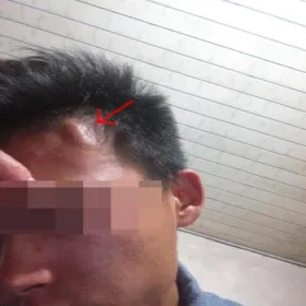 Guzek na czole choroba Kimury