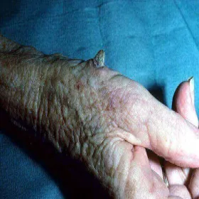 Guzek na dłoni róg skórny 