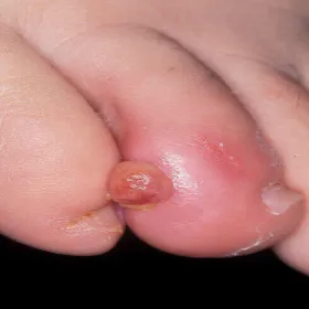 Guzek na palcu u nogi ziarniniak